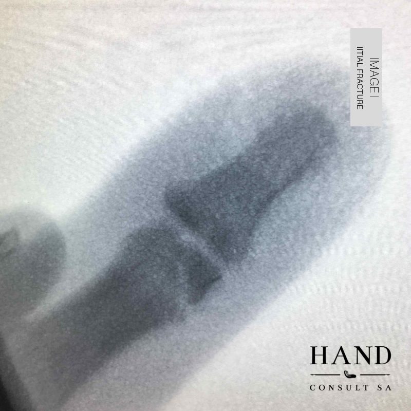 Finger Fractures - you can change your mind about the management.