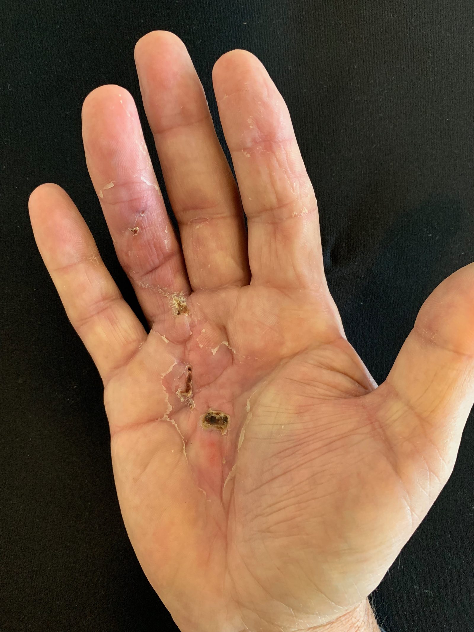 Ian's Journey following Dupuytren's Fasciectomy