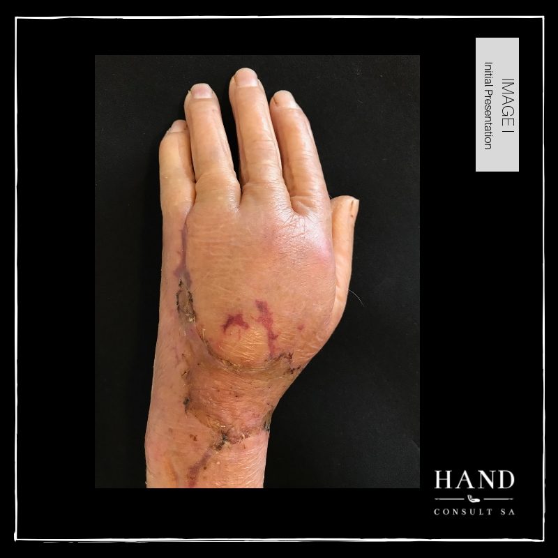Necrotic Wound & Fractured Finger in an Elderly Lady