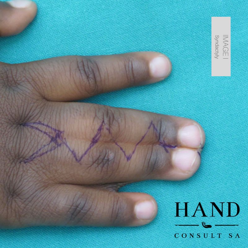Syndactyly