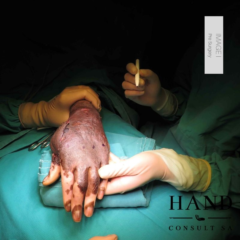 Joe's Journey: Operation I Superficial Iliac Artery Groin Flap and Web Creep Release