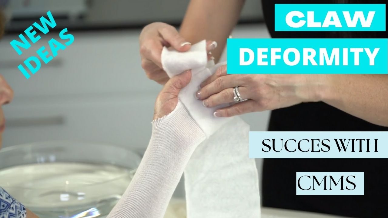 Claw Deformity? Try a New Technique