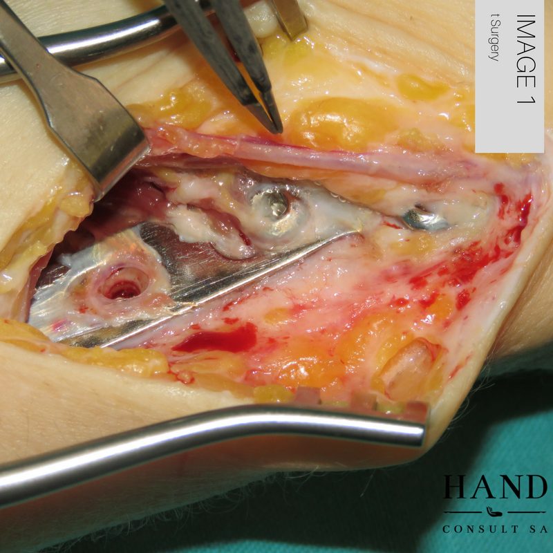 Removal of Distal Radius Plate
