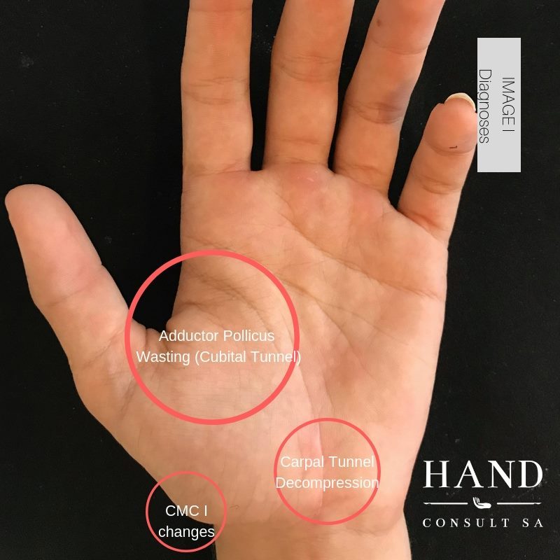 Cubital & Carpal Tunnel in a 14 year old Rower