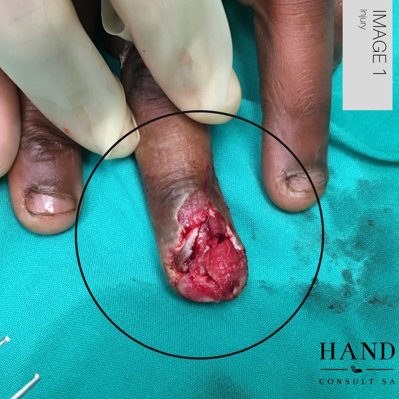 A Middle finger crush injury
