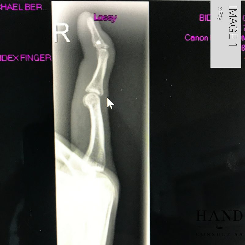 Mallet Finger Injury - Splint Position