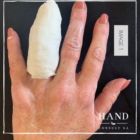 PIPJ Boutonniere Deformity - Serial Casting