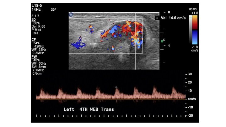 Rare Lipoma of the Tendon Sheath of the Fifth Extensor Compartment of the Hand