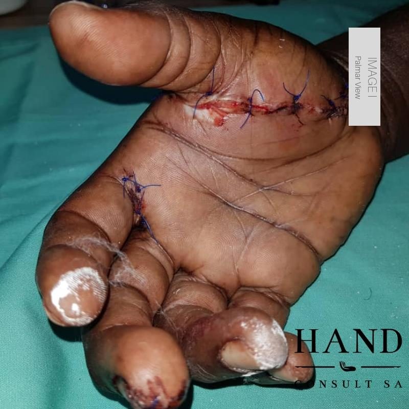 Fireworks Injury - Initial Injury
