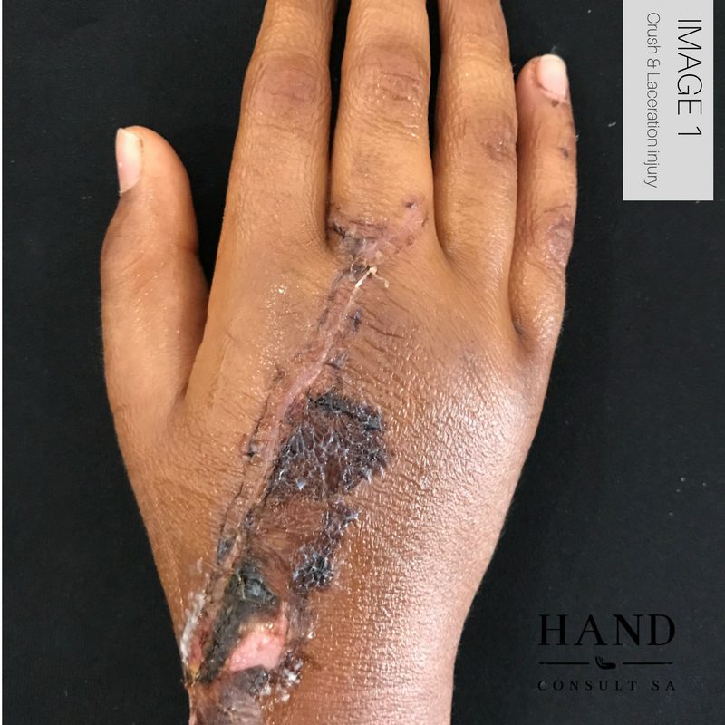 Crush & Laceration Injury
