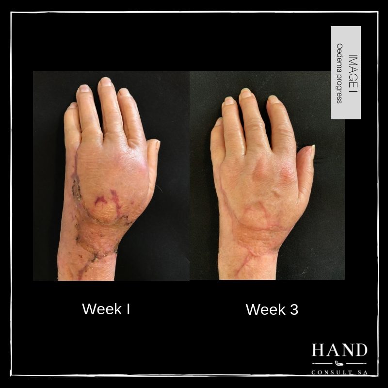 Necrotic Wound & Fractured Finger - Progress Images