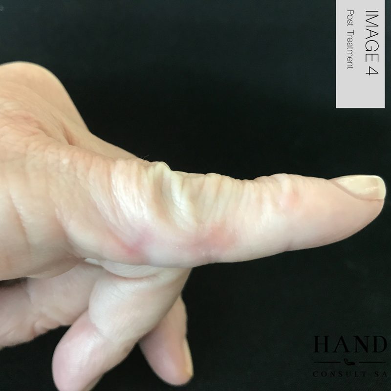 Swan Neck Deformity
