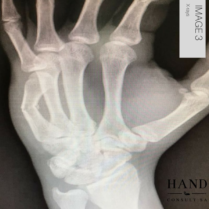 5th Metacarpal Fracture with angulation deformity