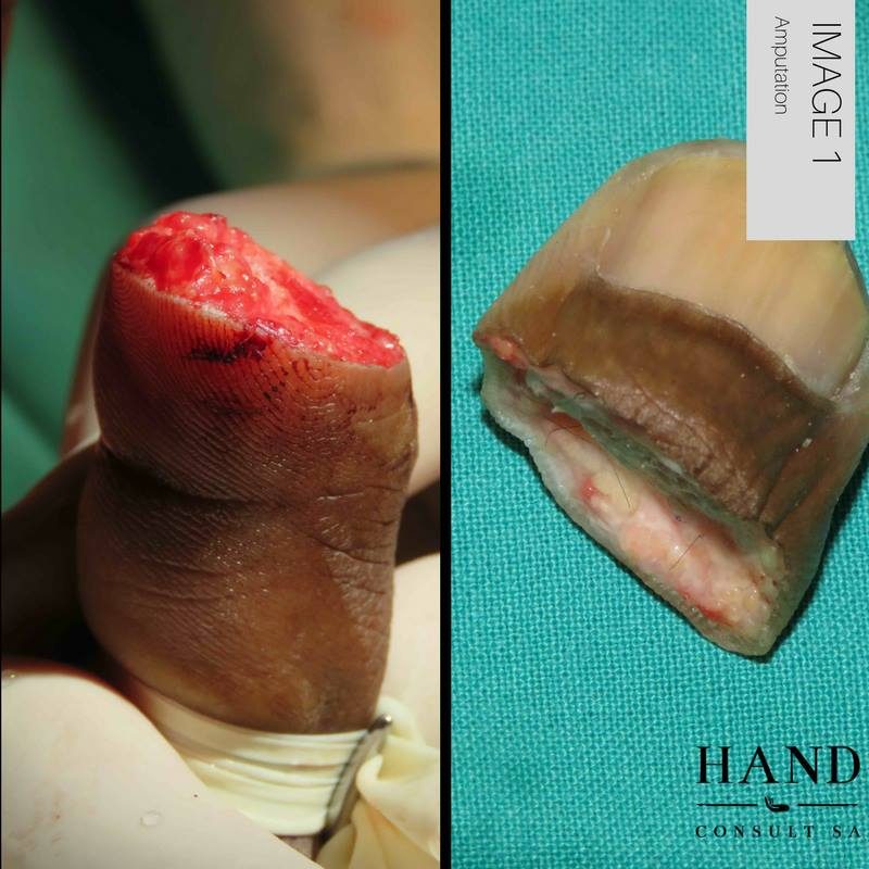Thumb Re-Plantation