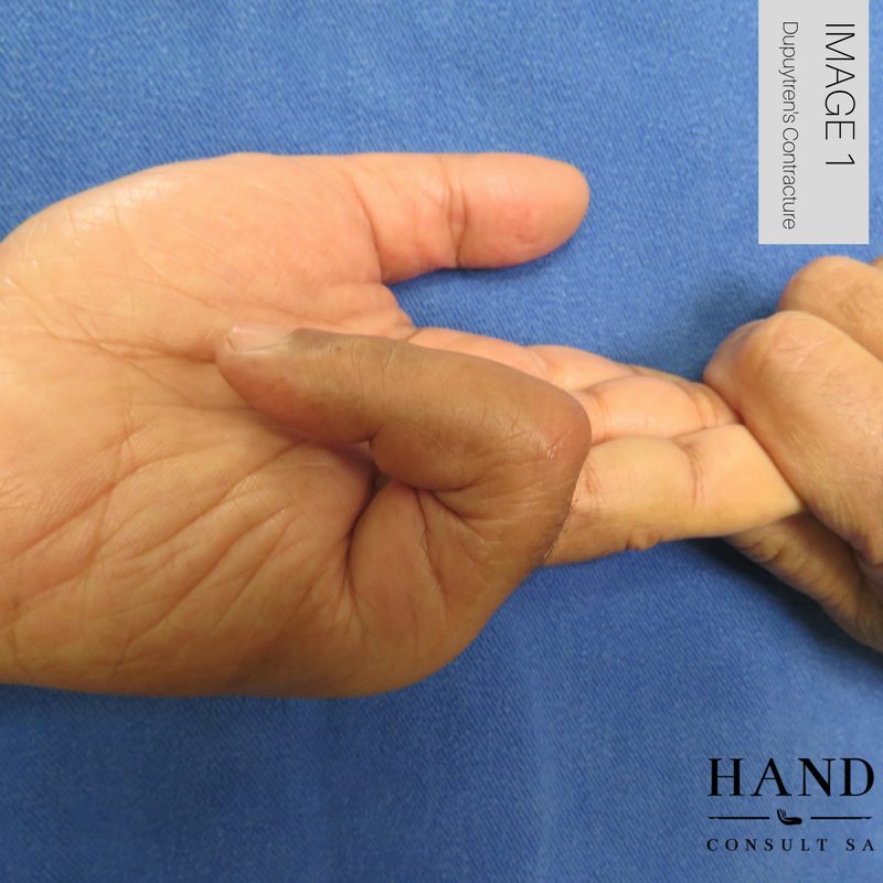 Dupuytren's Fasciectomy