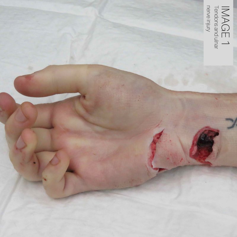 Tendon & Ulnar Nerve Injury