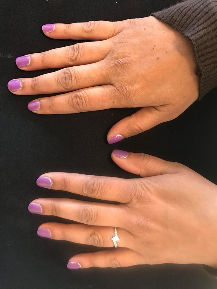 Raynaud's Disease - Patient's self diagnosis.