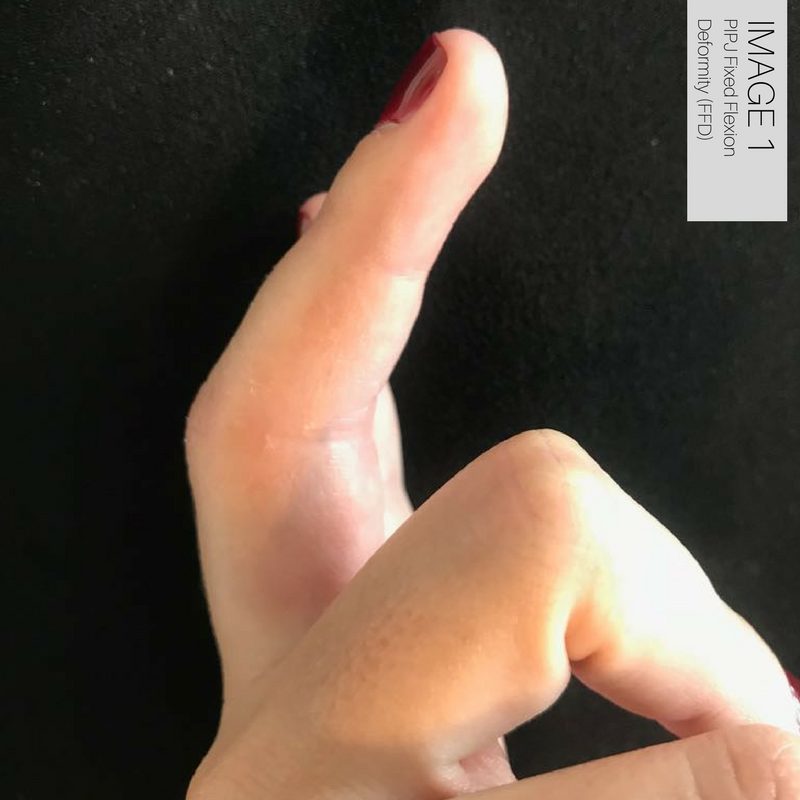 Proximal Interphalangeal Joint Injuries
