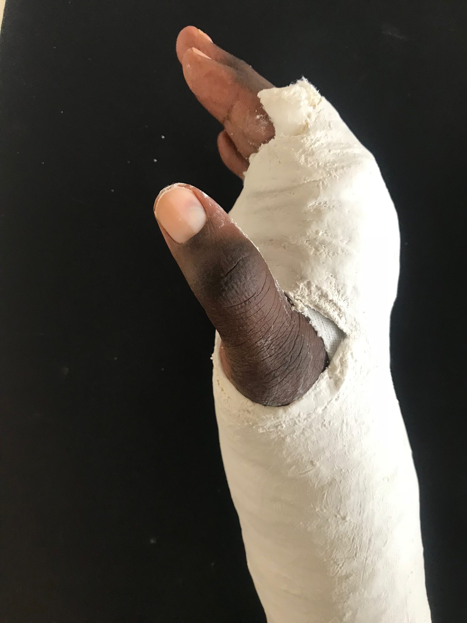 Fireworks Injury - CMMS Treatment