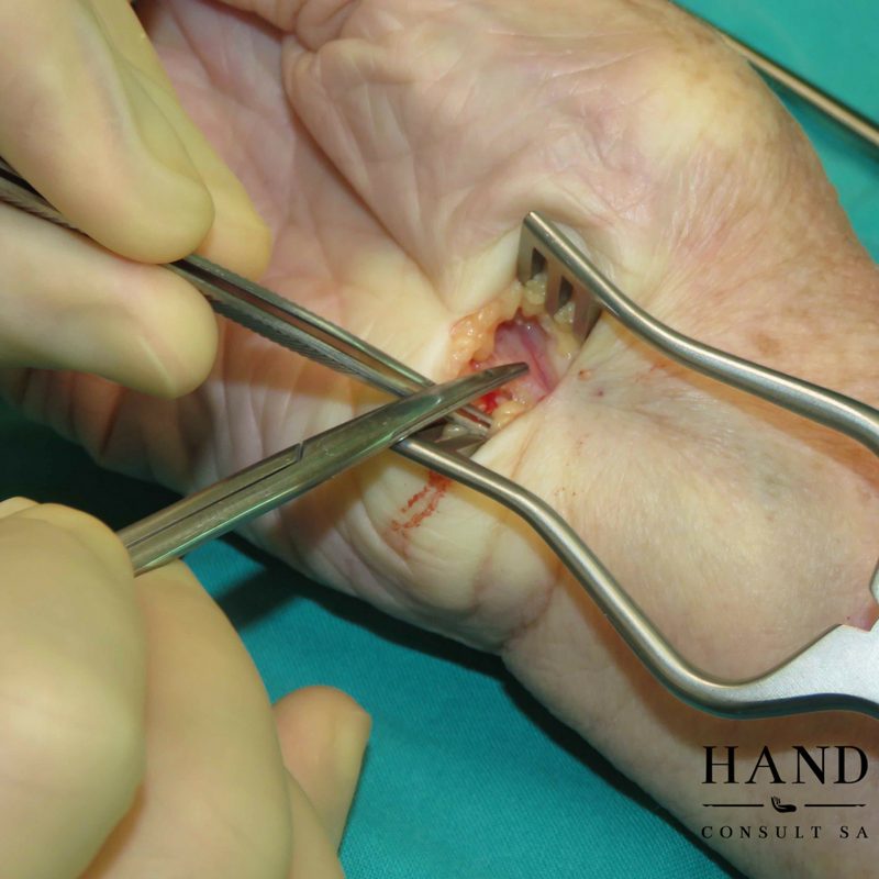Intra-Operative View of the Median Nerve
