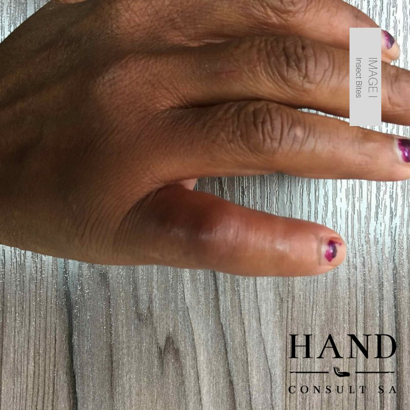 Insect Bites and Hand Infections