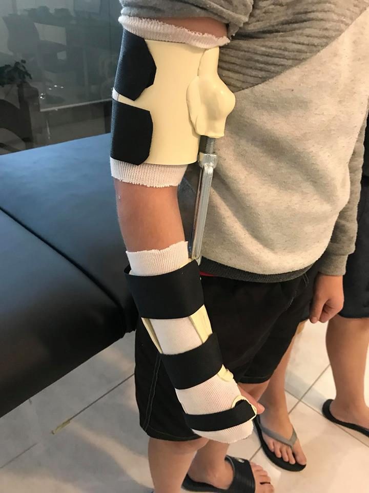 Elbow Fracture - Turnbuckle Splint