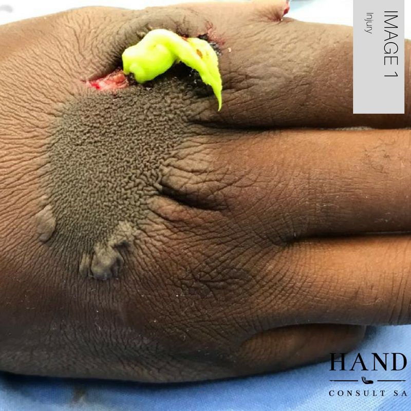 High Pressure Plastic Mold Injection Injury