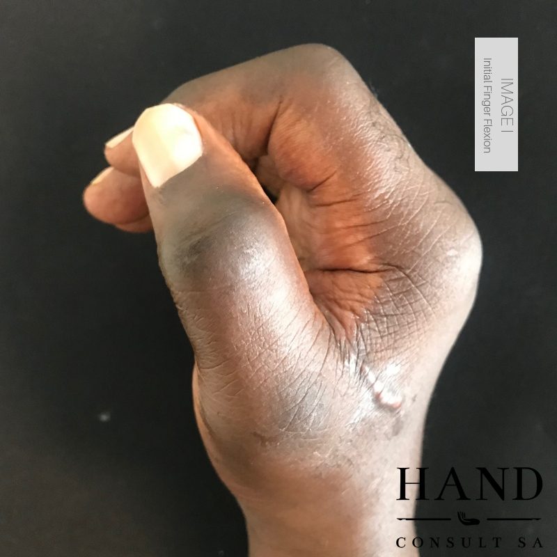 Fireworks Injury - Results