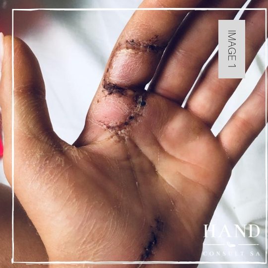 Flexor Tendon Repairs - Old Protocol, Poor Results. Why small changes can make a big difference.