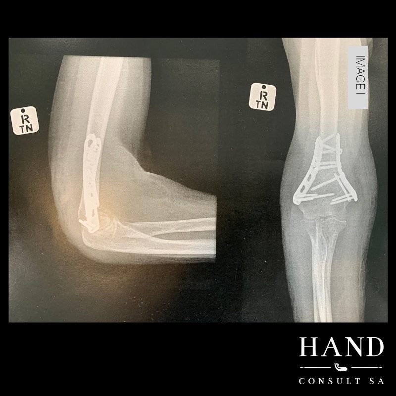 Fractured Elbow & Wrist - Secondary problems develop