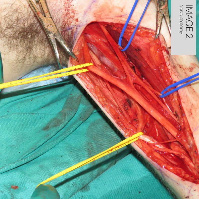 Brachial Plexus Injury