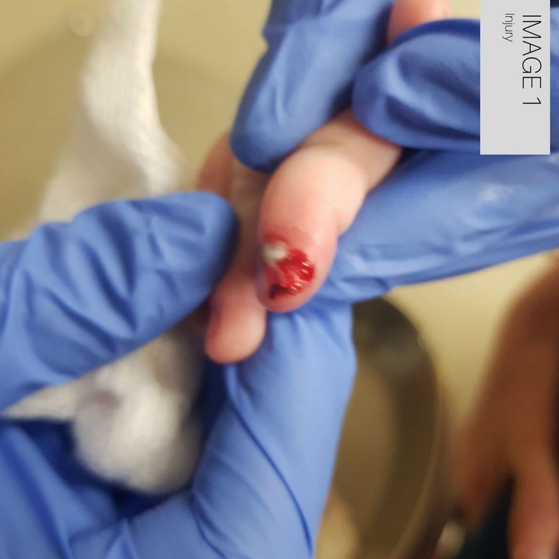 Finger Injuries in Children