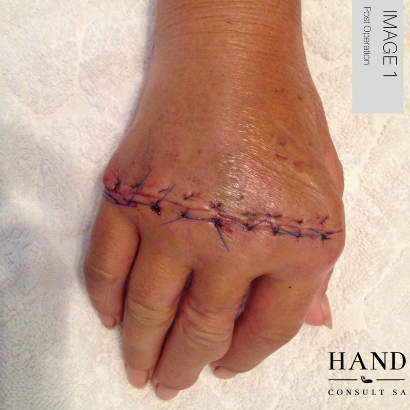 Rheumatoid Arthritis