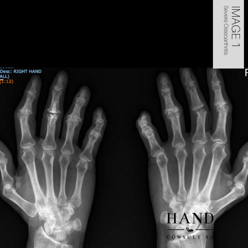 Finger Joint Replacements