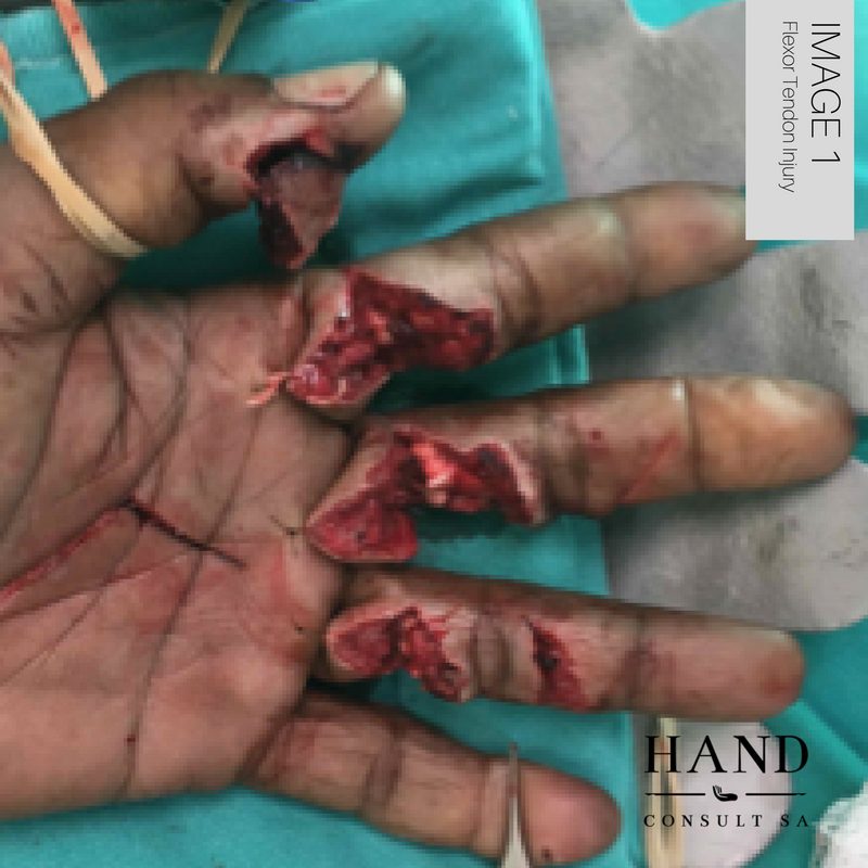 Flexor Tendon Hand Inury