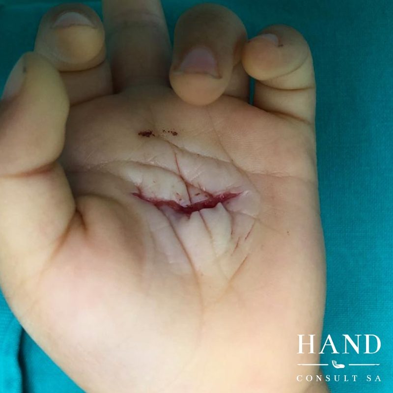 Glass cut to the palm of a 1 year old